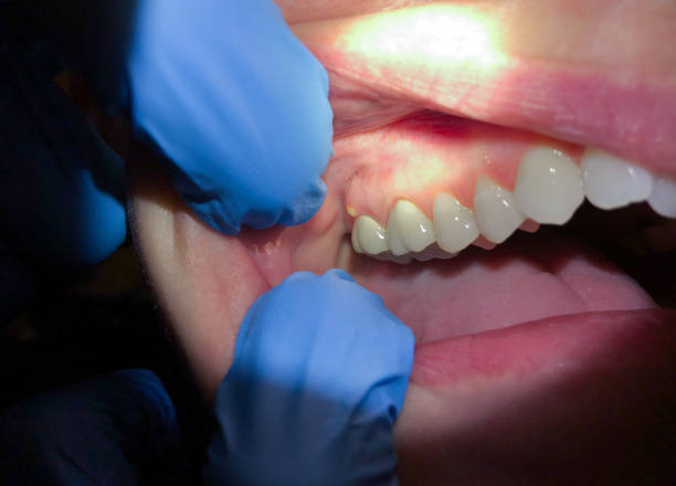 Best Emergency Treatment for Oral Infections in Plattsmouth, NE